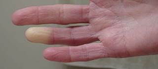 Large treatment effect in secondary RP Large treatment effect in secondary RP