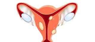 Ulipristal superior to placebo to achieve amenorrhea for bleeding due to symptomatic uterine leiomyomas Ulipristal superior to placebo to achieve amenorrhea for bleeding due to symptomatic uterine leiomyomas