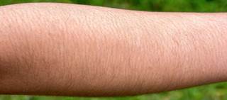 Women with an abnormal hirsutism score should be tested for elevated androgen levels Women with an abnormal hirsutism score should be tested for elevated androgen levels