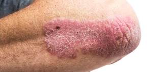 FDA approval was supported by data from the pivotal Phase-3 reSURFACE clinical development program FDA approval was supported by data from the pivotal Phase-3 reSURFACE clinical development program
