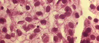 Women with DES-related clear-cell adenocarcinoma had 27-fold higher mortality at 10 to 34 years Women with DES-related clear-cell adenocarcinoma had 27-fold higher mortality at 10 to 34 years