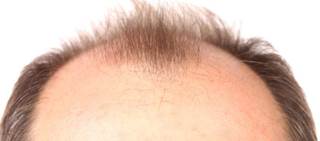 An osteoporosis Tx may promote hair growth to the same magnitude as CsA (if not better), and without its side effects. An osteoporosis Tx may promote hair growth to the same magnitude as CsA (if not better), and without its side effects.