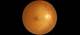 Implant to Reduce Intraocular Pressure in Glaucoma Shows Promise Implant to Reduce Intraocular Pressure in Glaucoma Shows Promise