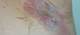 Bermekimab Looks Promising for Hidradenitis Suppurativa Bermekimab Looks Promising for Hidradenitis Suppurativa