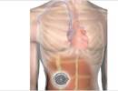 Implantable System for Remodulin Approved for Patients With PAH Implantable System for Remodulin Approved for Patients With PAH