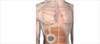 Implantable System for Remodulin Approved for Patients With PAH Implantable System for Remodulin Approved for Patients With PAH