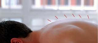 Acupuncture results sometimes compared to sham acupuncture, not pain meds; bias can affect research Acupuncture results sometimes compared to sham acupuncture, not pain meds; bias can affect research