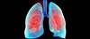 Treatment for Bronchiolitis Obliterans Gains Orphan Drug Status Treatment for Bronchiolitis Obliterans Gains Orphan Drug Status