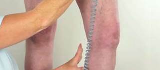 Mendelian randomization analysis provides evidence that increased height causally tied to varicose veins. Mendelian randomization analysis provides evidence that increased height causally tied to varicose veins.