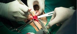 Within the first year, 70 patients who initially received antibiotics underwent appendectomy Within the first year, 70 patients who initially received antibiotics underwent appendectomy