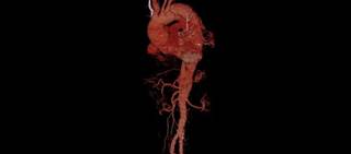 The recall is due to continued reports of both Type IIIa and IIIb endoleaks. The recall is due to continued reports of both Type IIIa and IIIb endoleaks.