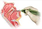 FDA Clears Elevo Kit Snoring Intervention Device FDA Clears Elevo Kit Snoring Intervention Device